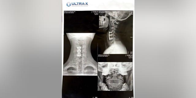 A fitness fanatic was left paralysed from the neck down after she fell on her head while doing an upside down sit up in the gym.
Marcelle Mancuso, 23, smashed a vertebrae in her neck when she tumbled off equipment head-first and doctors feared she might never move her limbs again.
Surgeons fitted a titanium plate held by six screws into her spine and she endured months of physical therapy to regain her movement a toe or finger at a time.
Now the law graduate is fighting fit and back at the gym with a new appreciation for being able to do simple tasks on her own.