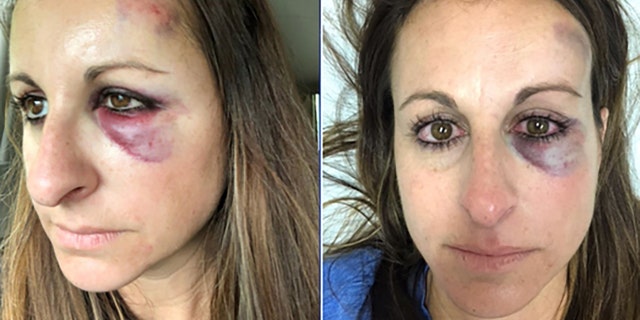 Sabrina Pattie was hit in the face by a puck at a Tampa Bay Lightning playoff game.
