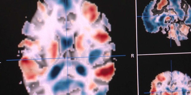 An example of brain activation from the Neurovault database. Red areas are activated by a particular task, blue areas are deactivated.