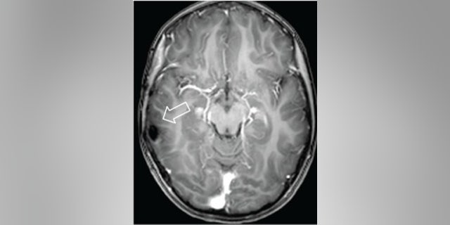 Tawa gadis yang tak terkendali disebabkan oleh tumor otak