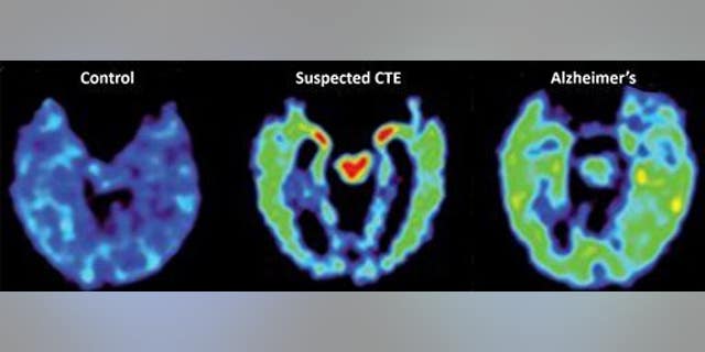 Scans of a normal brain, a brain with suspected CTE, and a brain affected by Alzheimer's.