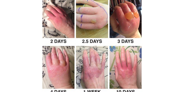 Scars from Giant Hogweed sap can last up to six years, though typically only last a few months.