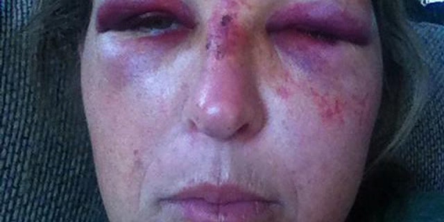 Martha McClure was injured when she was allegedly hit in the face with a shovel.