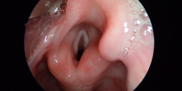 In this photo provided by J. Scott McMurray Md., Associated Professor, University of Wisconsin School of Medicine and Public Health, taken Oct. 14, 2011, shows a normal larynx and vocal folds, center, during surgery in Madison, Wis. Our voices are the main way we communicate, one we mostly take for granted until something goes wrong. Now researchers have grown human vocal cords in the laboratory, a step toward one day helping to restore a voice to people who have lost theirs to disease or injury. (J. Scott McMurray, Md./University of Wisconsin School of Medicine and Public Health via AP)