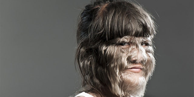 Supatra "Nat" Sasuphan, the world's hairiest child.