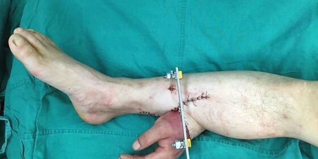Doctors performed an extraordinary operation to save a mans severed hand by attaching it to his leg.