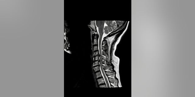 De preoperatieve cervicale wervelkolom van de auteur toont compressie van het ruggenmerg in drie regio's.