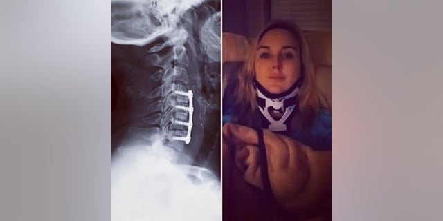 An image following after surgery showing titanium plate, screws and implants from bone bank