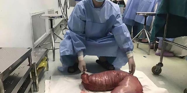 The section of colon that was removed was 30 inches long and weighed nearly 29 lbs.