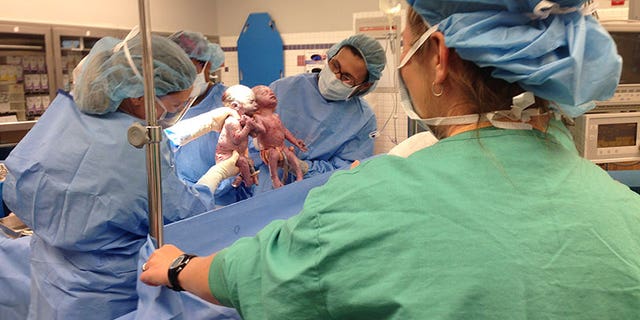 Jenna and Jillian were born holding hands two years ago.