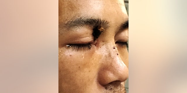 Doctors in China have pulled a 7-inch tree branch from Wu Xuan's injured right eye.