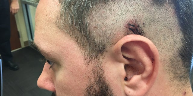 Chris McFarland shows where the bullet grazed his head Sunday afternoon.
