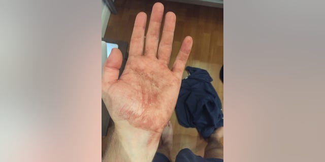 The bloodied hand of Mark Kindschuh, 19, a Boston College student who helped save a man's life during the London terrorist attack.