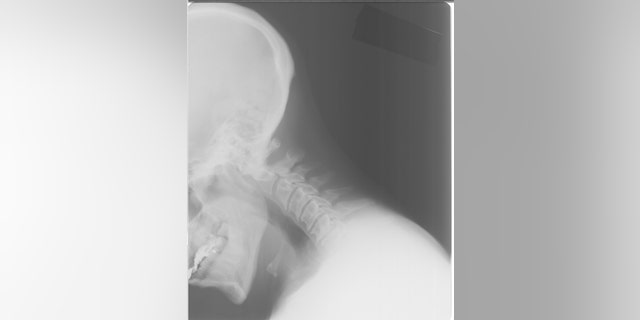 A neck X-ray image