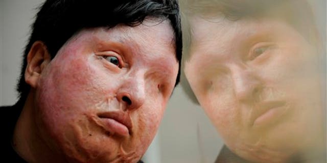 In this March 4, 2009 file photo, Ameneh Bahrami, who was blinded and disfigured by a man who poured acid on her face in 2004 for rejecting his marriage proposal, poses for a portrait at a hospital in Barcelona, Spain.