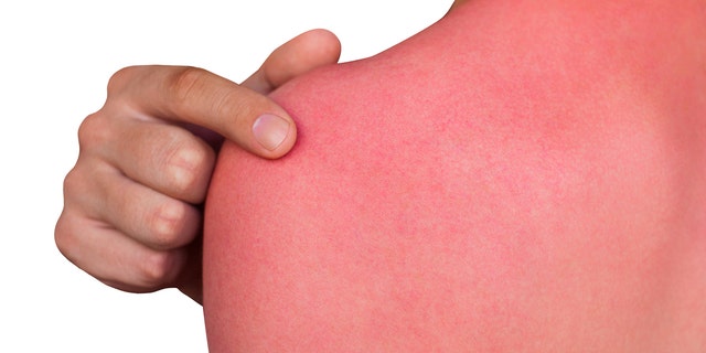 We’re at risk for sunburn and skin damage anytime the UV index is moderate to high.