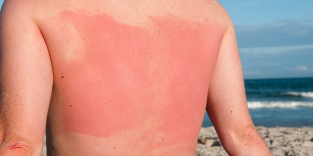 Rigel suggests cooling lotions containing menthol and 1% hydrocortisone cream to treat inflammation as well as aspirin to treat any swelling, redness or discomfort.