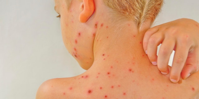 Upper back of young boy, 5 years, blond short hair, with red chickenpox on his shoulders, neck and cheek. He is scratching his back with right hand.