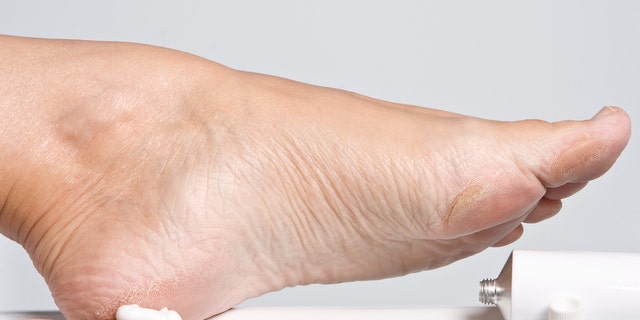 Female hands treating dry feet with moisturizing cream