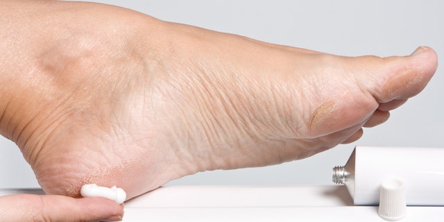 Female hands treating dry feet with moisturizing cream