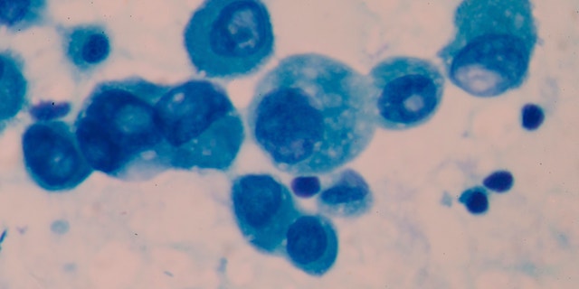Cancer Cell in blood cells human showing abnormal cells.