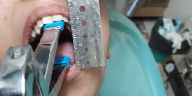 During a four-hour operation, doctors in India were able to remove the tumor that was sitting on Fatima's jaw joint.