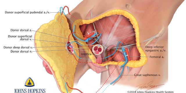 Saying they wanted to address "an unspoken injury of war," Johns Hopkins University surgeons rebuilt the man's entire pelvic region — transplanting a penis, scrotum and part of the abdominal wall from a deceased donor — in a highly experimental 14-hour operation last month.