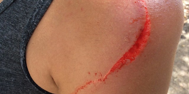 One official said most of the attacks cause lacerations or significant scratching.