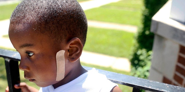 Kavan Collins, a month after he was shot in the face in June 2016.