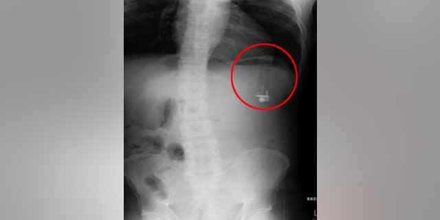 An X-ray revealed the upside-down lighter in the man's abdomen.