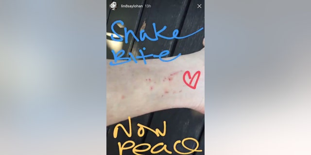 Lindsay Lohan shares snake bite image on social media.