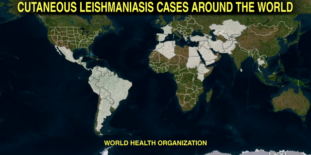 Cutaneous Leishmaniasis affects about 1.2 million people each year in 88 countries.