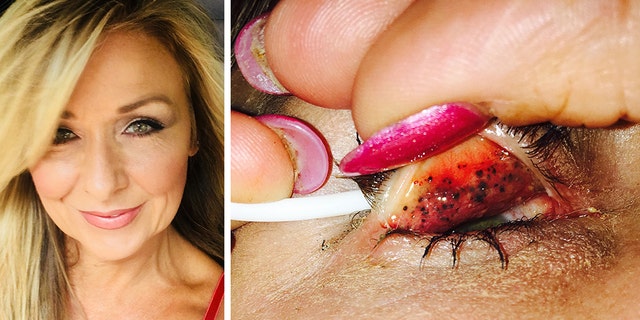 Theresa Lynch, 50, left her mascara on for 25 years and a doctor discovered something shocking underneath her eyelids. Now, Lynch is warning others to "properly take your makeup off every single night."