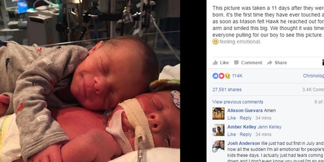 Newborn Seen In Viral Photo Hugging Twin Brother Dies Of Rare Disorder 