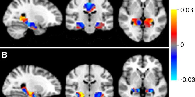 Discrimination maps for classifying mild cognitive impairment (MCI) subgroups, inside the masks that resulted in the highest accuracies. A: between patients with MCI that converted to Alzheimer's disease (MCIc) and s