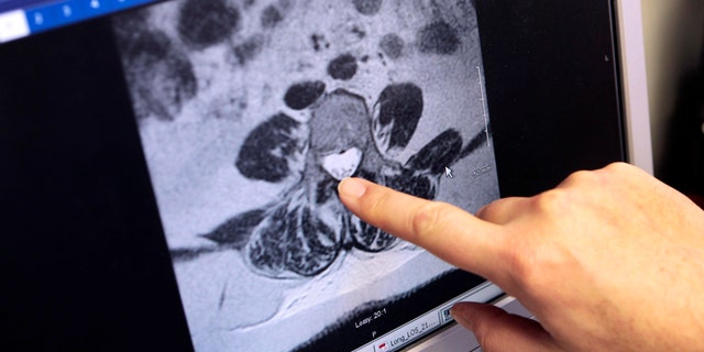 A doctor shows a digital slide of a patients MRI, showing the infected area of the spine in a meningitis case. (REUTERS/Rebecca Cook)