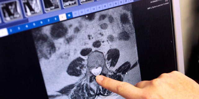 A doctor shows a digital slide of a patients MRI, showing the infected area of the spine in a meningitis case. (REUTERS/Rebecca Cook)