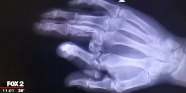 The X-ray above shows the right hand of Oakland County Sheriff Deputy Tom Kangas.