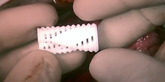 Final 3D-printed tracheobronchial splint used to treat the left bronchus of patient 2. The splint incorporated a spiral to accommodate concurrent use of a right bronchial splint and growth of the right bronchus.