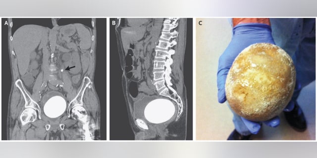 The panel on the left shows a scan of the man's abdomen. The middle panel shows the man's abdomen from the side, and the panel on the right shows the egg-shaped neobladder stone after it was surgically removed.