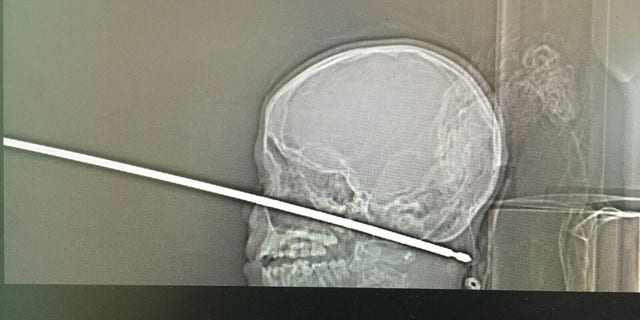 The X-ray shows the skewer that went into the boy's face.