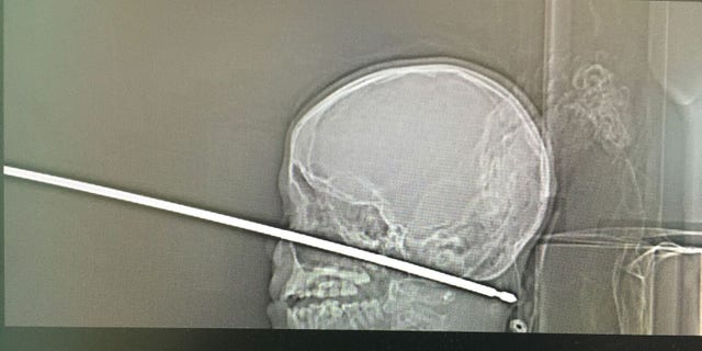 The X-ray shows the skewer that went into the boy's face.