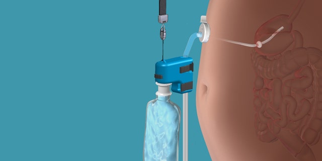 This rendering provided by Aspire Bariatrics, Inc. demonstrates the use of the AspireAssist weight loss device, approved by the Food and Drug Administration on Tuesday, June 14, 2016. The AspireAssist system consists of a thin tube implanted in the stomach, connecting to an outside port on the skin of the belly, which itself is connected to an external device, which helps remove nearly a third of the food stored in the stomach before calories are absorbed into the body, causing weight loss. (Aspire Bariatrics, Inc. via AP) MANDATORY CREDIT