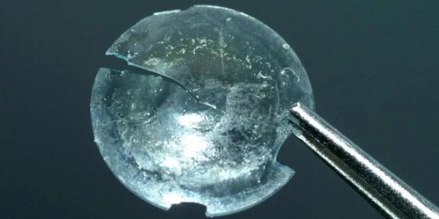 Once the cyst was removed from the woman's eye, it broke open, revealing an extremely fragile hard contact lens inside.
