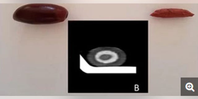 An olive and its pit; the inset image is a scan of a single black olive, which is similar in appearance to the olive in the man's gut.