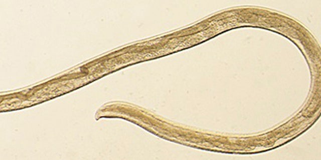 This undated photo provided by the Centers for Disease Control and Prevention (CDC) shows Thelazia gulosa, a type of eye worm seen in cattle in the northern United States and southern Canada, but never before in humans.