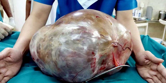 It took doctors one and a half hours to remove a massive 26-pound tumor from a woman in India.