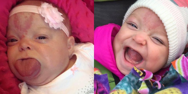 Paisley Kienow is pictured before surgery, left, and after.