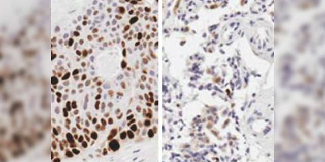 Compared to a control (left), mice treated with a chemotherapy drug using the device experienced significant growth reduction as confirmed by the lack of brown staining for a marker of tumor growth. Photo Credit: University of North Carolina at Chapel Hill