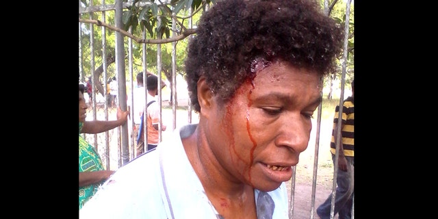 June 8, 2016: In this photo provided by Staycey Yalo, 34-year-old Esther Was bleeds from a head wound suffered during a student protest in Port Moresby, Papua New Guinea.